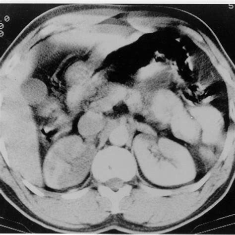 Ct Scan Of Abdomen With Intravenous And Oral Contrast Download