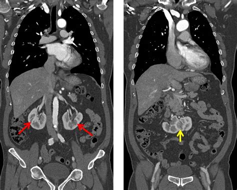 Horseshoe Kidney Radiology Cases