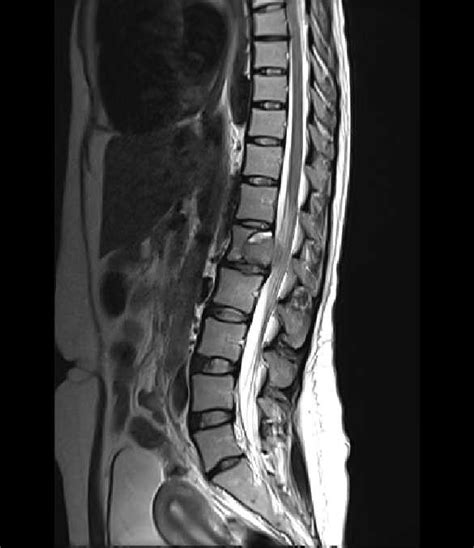Giant Cell Tumor Spine Image