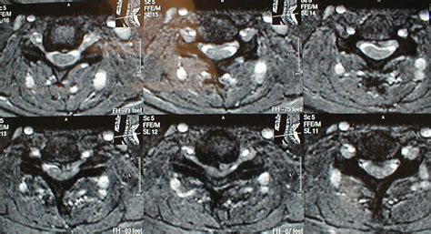 53 Yo Male With Cervical Stenosis And Myelopathy Treated With Anterior