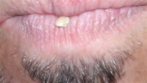 Popping Hidden Tonsil Stones Magazineslopez