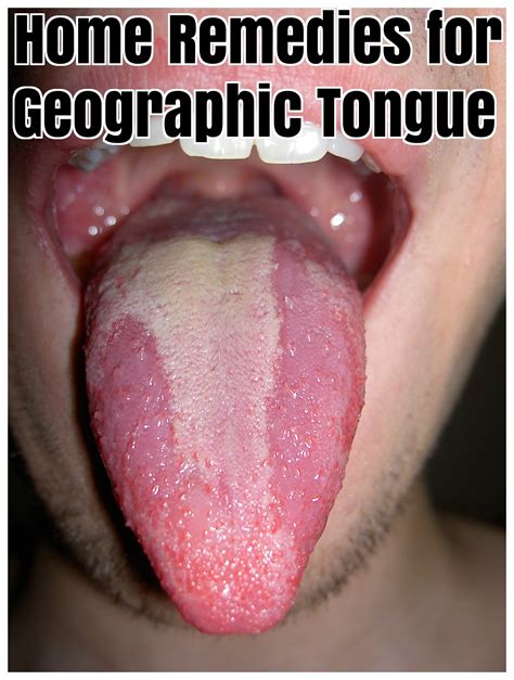 Top 10 Home Remedies For Treating Geographic Tongue