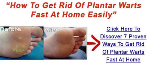 Get Rid Of Warts Naturally And Easily Using Simple Remedies Home