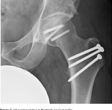 Figure 6 From Use Of The Trochanteric Flip Osteotomy To Facilitate