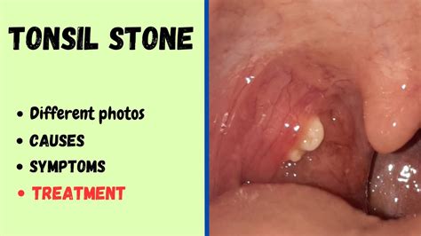Tonsil Stone Cause Symptoms Treatment And Photos Youtube