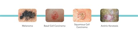Skin Cancer Diagnosis And Treatment Associates In Dermatology