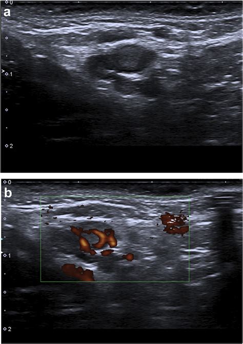 2a And 2b Ultrasound Of The Same Right Axillary Lymph Node Twelve