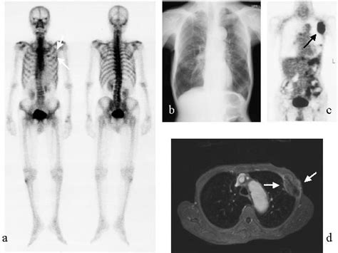 A Case Of Osteolytic Type Bone Metastasis Patient 2 Eighty Year Old