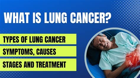 Lung Cancer Symptoms Causes Stages And Treatment Youtube