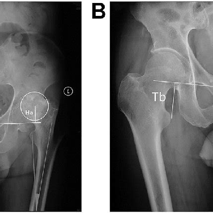 Knee Valgus Deformity KV Was Defined As Femoral Tibial Angle Of 170