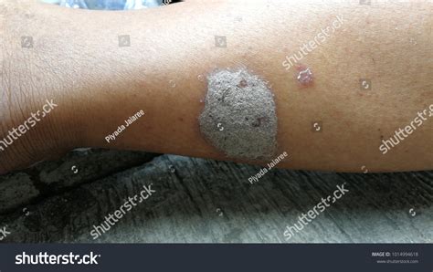 9157 Fungal Skin Infections Images Stock Photos And Vectors Shutterstock