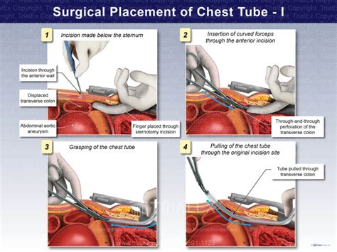Surgical Placement Of Chest Tube I Trialexhibits Inc