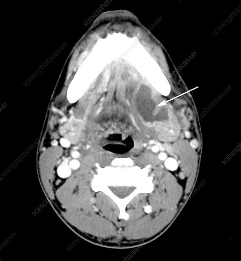 Submandibular Gland Abscess Ct Scan Stock Image C0270923 Science