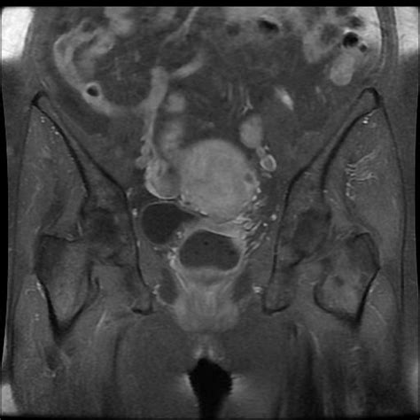 Endometrial Carcinoma Figo Stage 1a Image