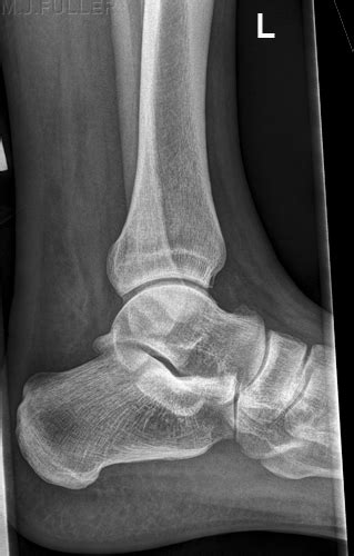 Lateral Ankle Radiography Wikiradiography