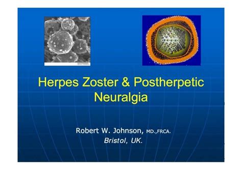 Herpes Zoster Andherpes Zoster And Postherpetic Neuralgia · Post Herpetic
