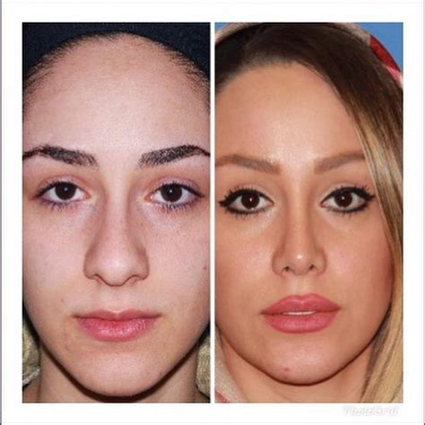 Rhinoplasty In Iran Types Of Nose And Methods Price