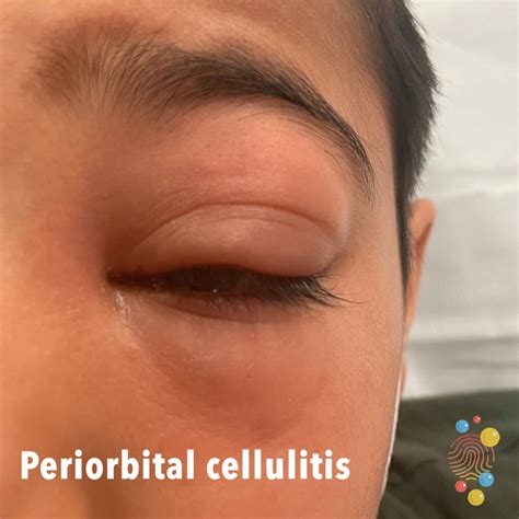 Peri Orbital Cellulitis Skin Deep