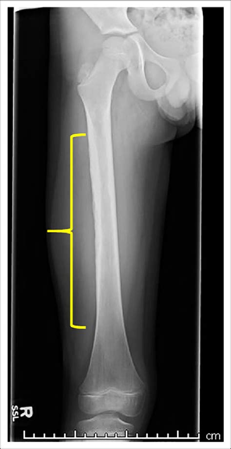 Frontal Radiograph Of The Right Femur Obtained For Swelling