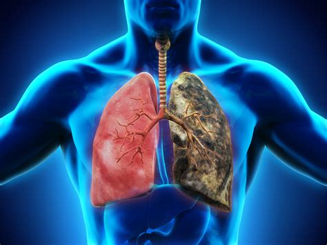 Lung Disease - Lung Cancer | Florida Lung Asthma & Sleep Specialists