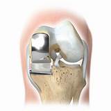 Partial Vs Total Knee Replacement Recovery