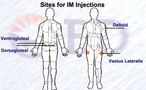 Sites For Intramuscular Im Injection Nursing School Info Nursing School Tips Top Nursing Schools