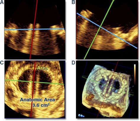 Direct Assessment Of Normal Mechanical Mitral Valve Orifice Area By