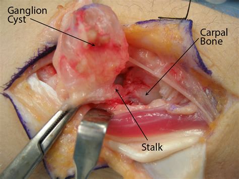 Ganglion Cyst Wrist