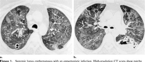 Figure 2 From Thoracic Manifestations Of Systemic Autoimmune Diseases