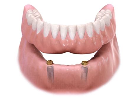 Implant Overdenture — Tri State Oral And Maxillofacial Surgery