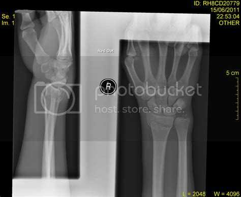 Broken Wrist Calling Stw Fracture Experts Singletrack World Magazine