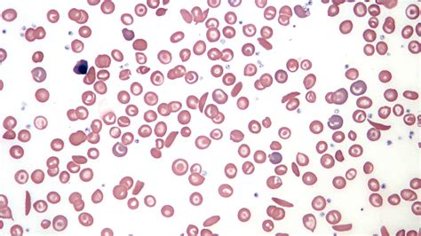 Sickle Cell Anemia Traced Back To One Baby Born 7300 Years Ago