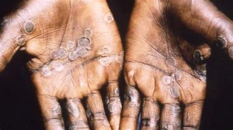 Uk Health Care Worker Contracts Rare Monkeypox Virus In Third Case