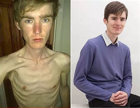 Anorexic People Before And After