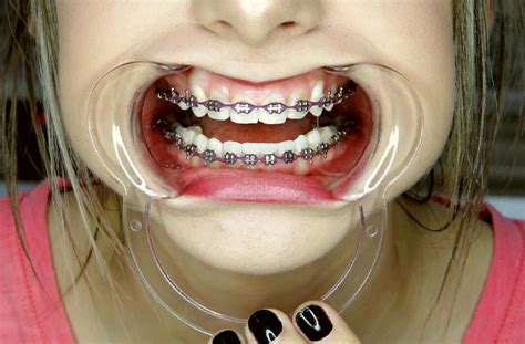 Braces Braceface Powerchain Metalbraces Girlswithbraces Tipos De