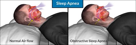 Tips To Help Sleep Apnea