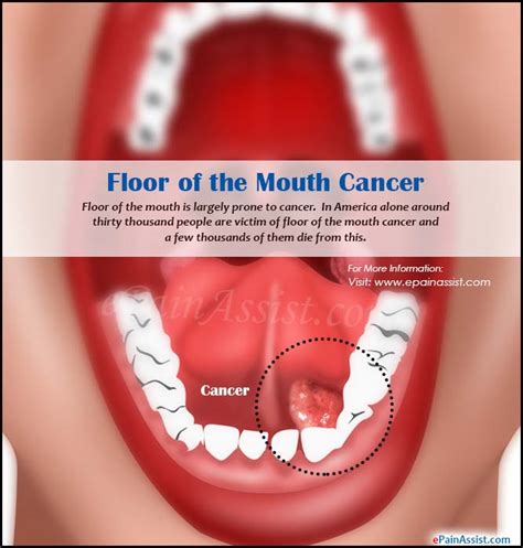 Floor Of Mouth Cancer Home Alqu