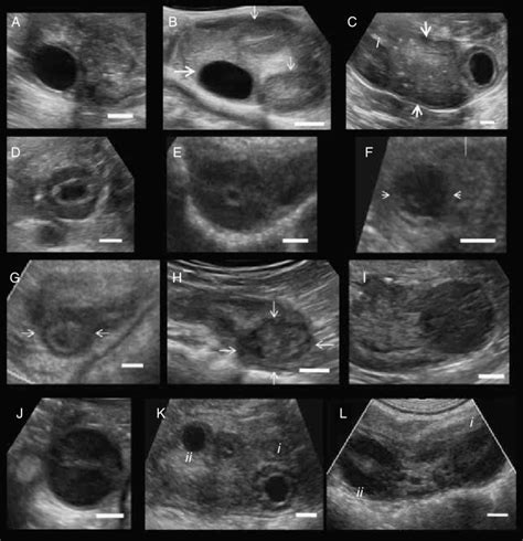 Ultrasonographic Images Of Different Stages Of Corpus Luteum Download Scientific Diagram