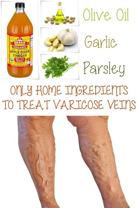 Home Remedies For Varicose Veins Reboot Your Health Varicose Vein
