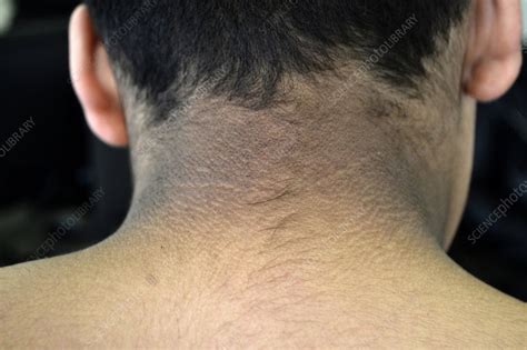 Acanthosis Nigricans Stock Image C0473481 Science Photo Library