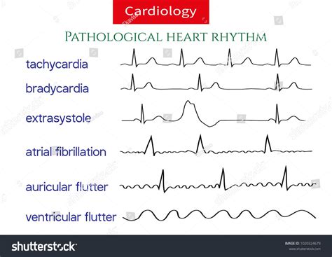Pathological Ecg Collection Shematic Vector Illustration Of Different