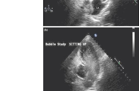 Transthoracic Echocardiogram Bubble Study In A Supine Position And