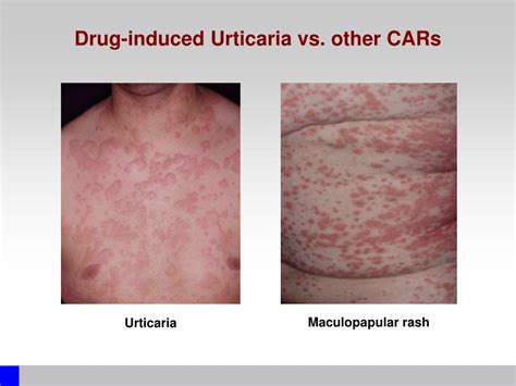 Ppt Drug Induced Urticaria Powerpoint Presentation Free Download