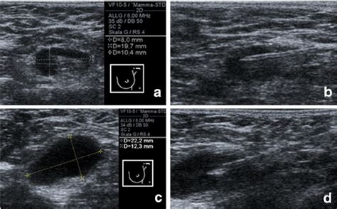 Examples Of Sonographically Suspicious Axillary Lymph Nodes That