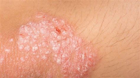 Conheça Os Melhores Remédios Naturais Para A Psoríase Eczema E Outros