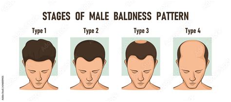 Stages Of Male Baldness Pattern Male Hair Loss Stock Vector Adobe Stock