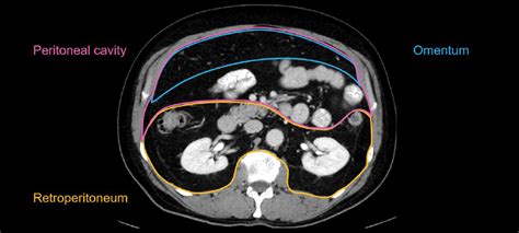 Abdominal Ct Peritoneal Cavity Litfl Radiology Library
