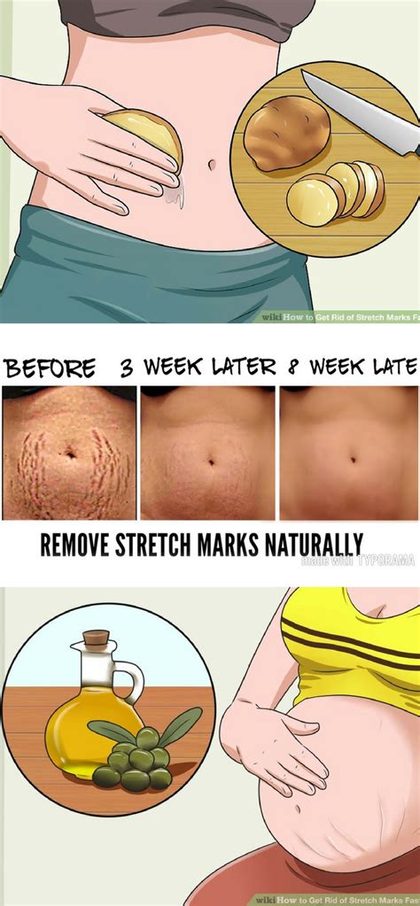 How To Remove Stretch Marks Fast In Weeks Gesundheit Stretch Mark