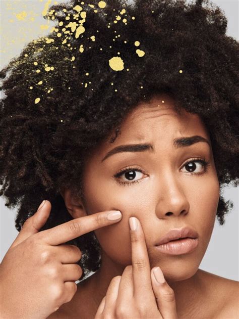 6 Hormonal Acne Causes You Need To Know Wellness Lifestyle Healthy