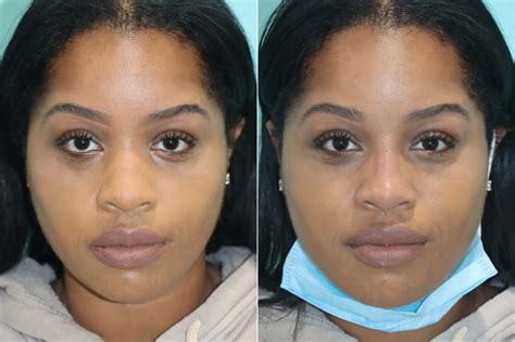 Non Surgical Rhinoplasty Photos Chevy Chase Md Patient